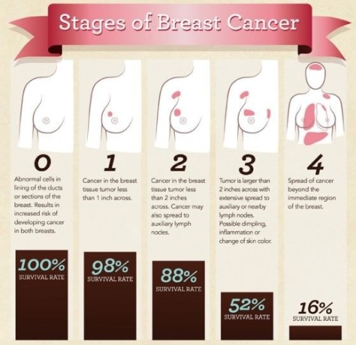 Stages of Breast Cancer